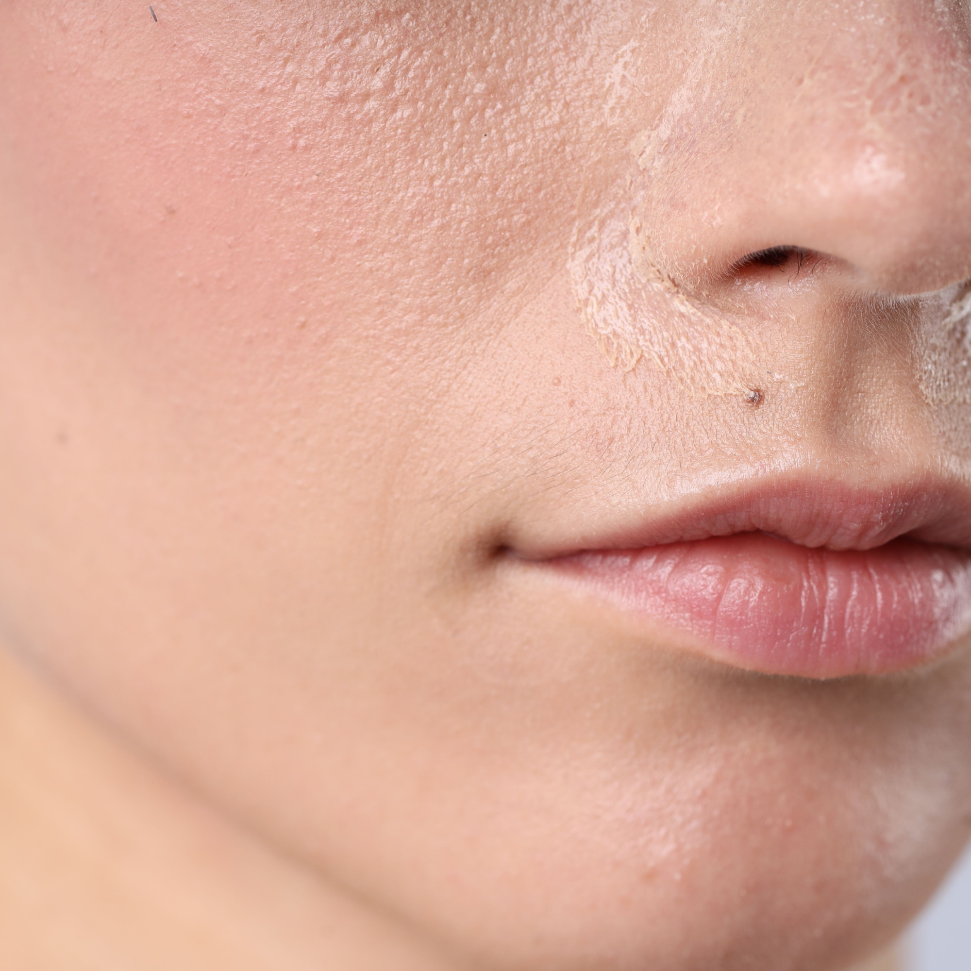 Dry Skin