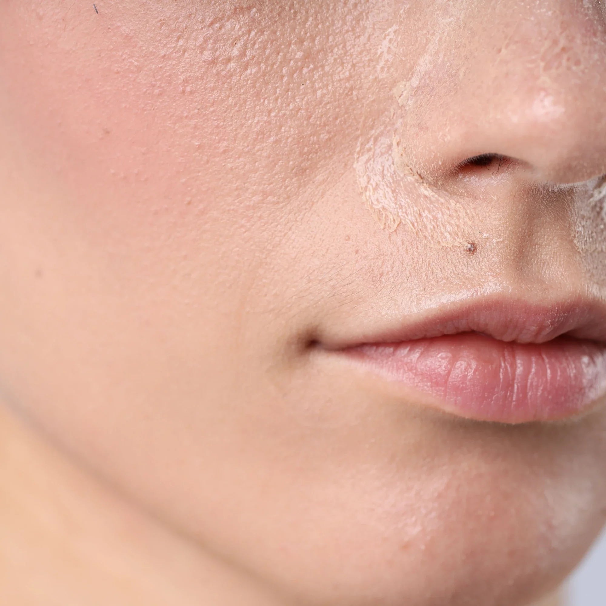 Dry Skin
