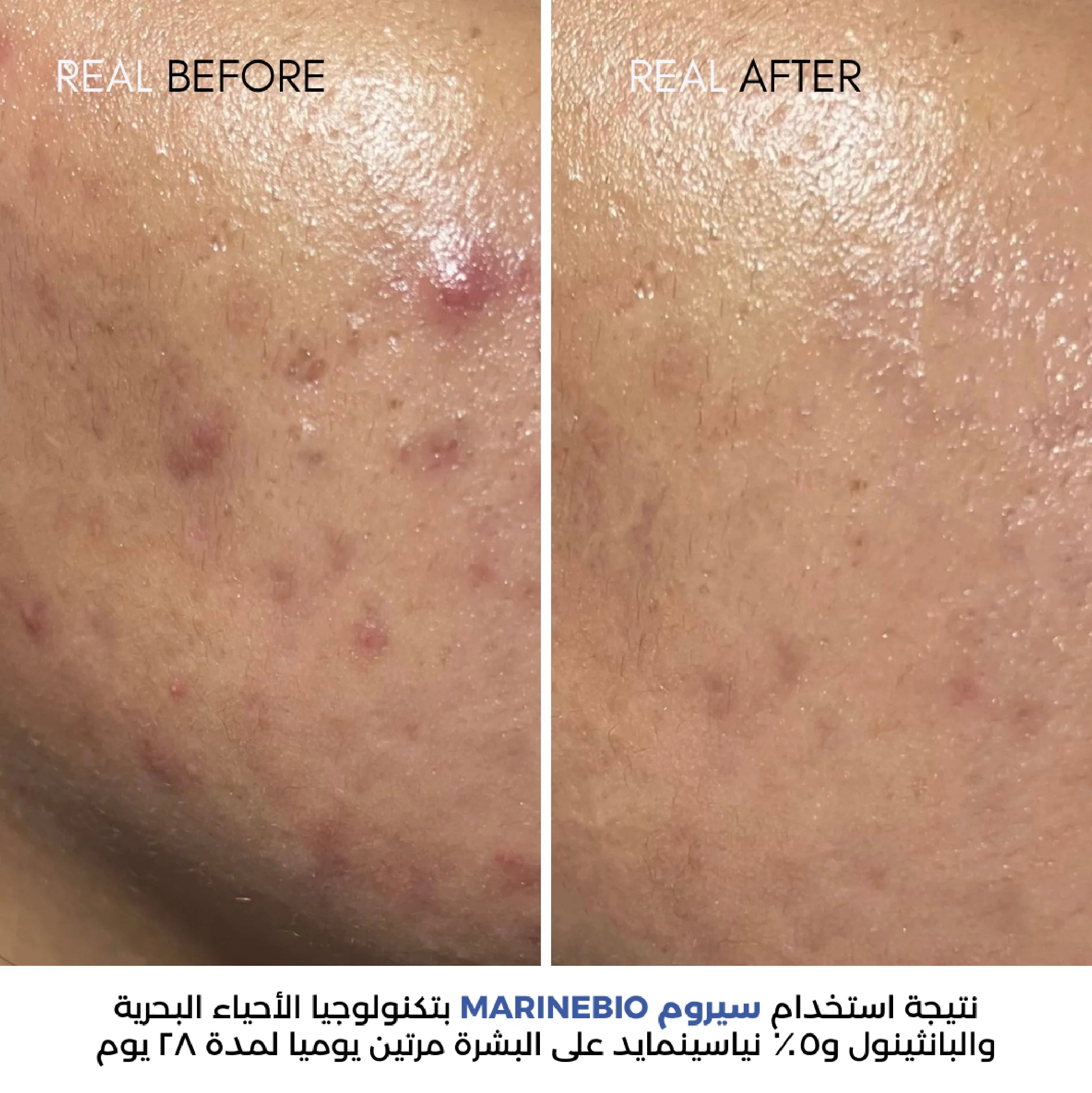 Before and after comparison of skin treatment with MARINEBIO product on a person's shoulder.
