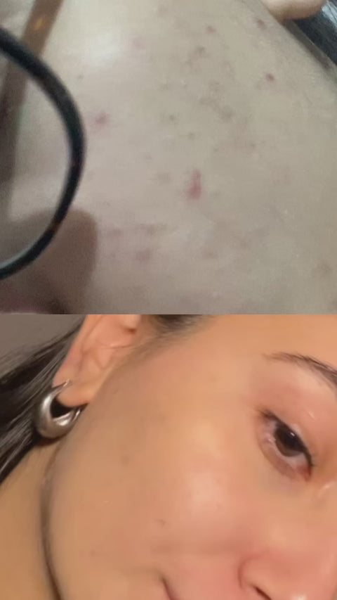 9% Niacinamide Kit