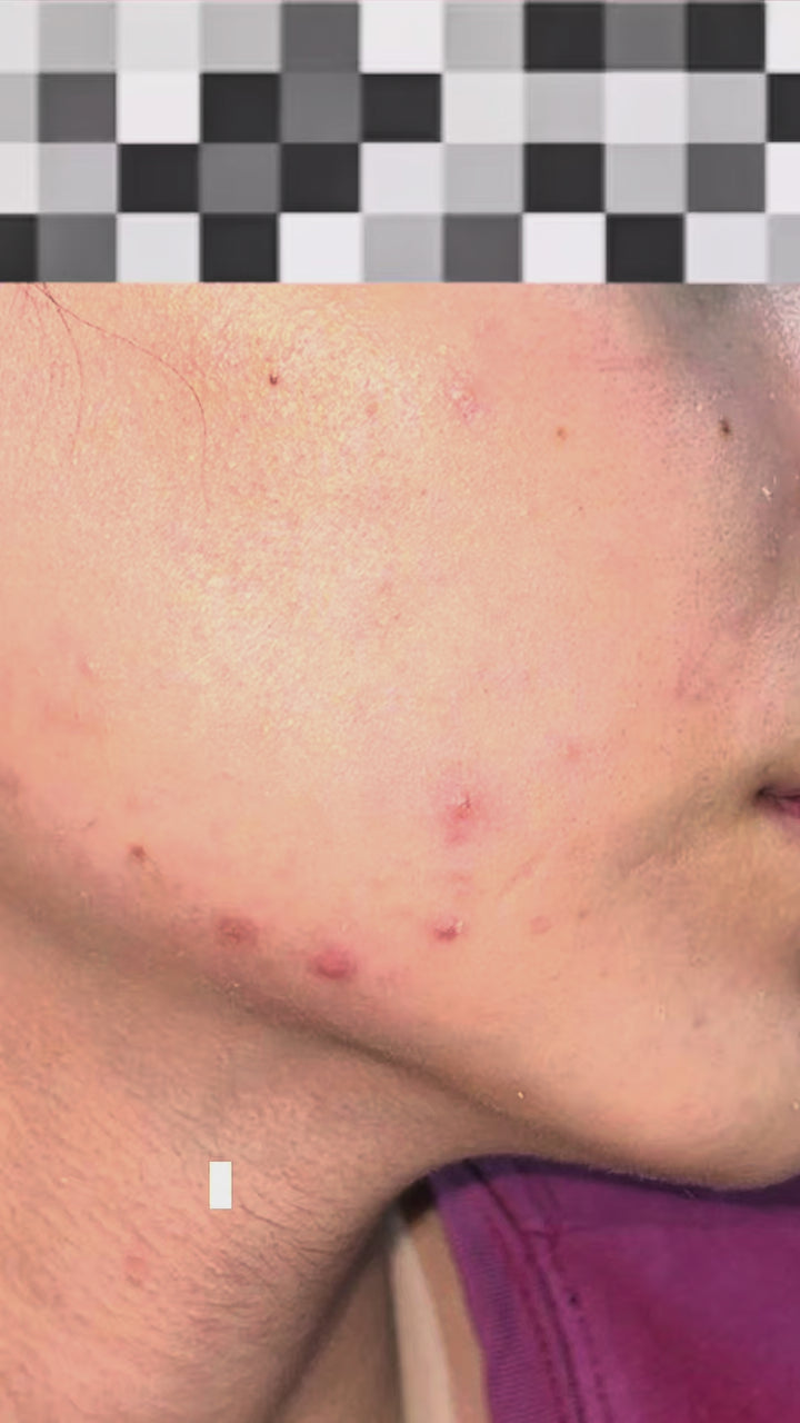 Winter Acne & Oil Control Routine